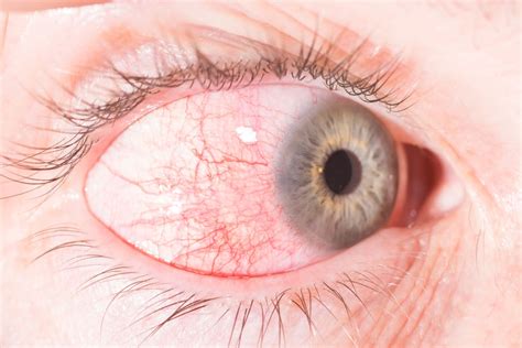 Find Relief: Expert Optometrist Shares the Best Treatment Options for Episcleritis